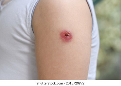 Hand Of A Kid With A Reaction To The BCG Vaccine