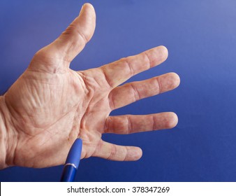 Hand of an man with Dupuytren contracture disease, pointing with pencil  on critical part, against medical blue background, space for text