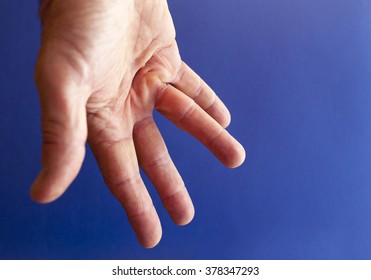 Hand of an man with Dupuytren contracture  disease, against  medical blue background