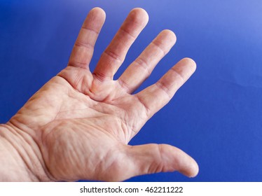 Hand of an man with Dupuytren contracture  disease, against  medical blue background 