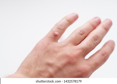 Hand Of A Man With A Wart