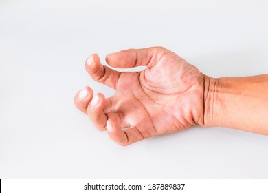 Hand Of Men With Symptoms Of Spasticity.