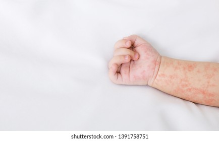 Hand Of Newborn Baby With Measles Rash On White Sheet, Closeup, Panorama With Free Space