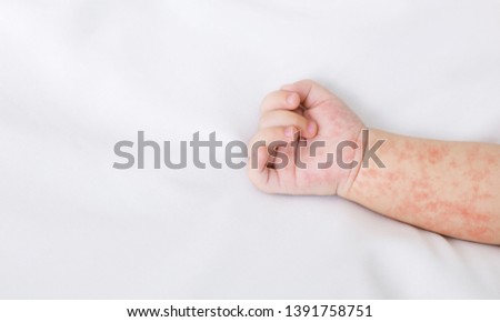 Hand of newborn baby with measles rash on white sheet, closeup, panorama with free space