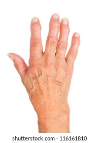 Hand Of An Old Woman With Arthritis, Isolated On White