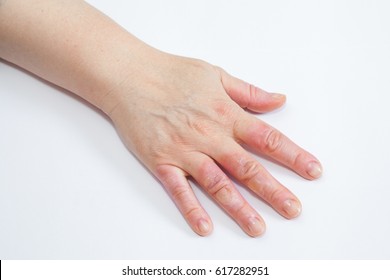 Hand on white with second degree burns on the fingers