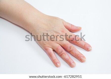 Hand on white with second degree burns on the fingers