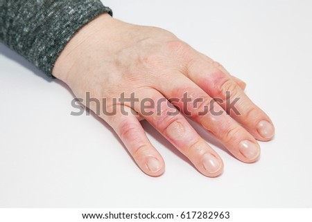 Hand on white with second degree burns on the fingers