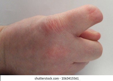 amputation of half of thumb Mature womens muscle legs