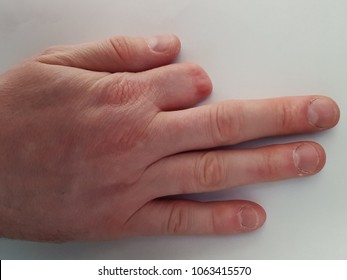 amputation of half of thumb Amputation of half of thumb