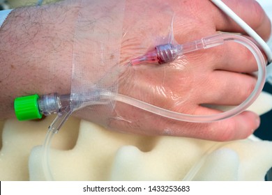 A Hand Of A Patient In Surgery,  A Crystalloid Infusion Going Through A 20G IV, A Cord From A  Pulse Oximeter Probe Running Across The Hand.  The Injection Port Is Covered With A Protective Cap.