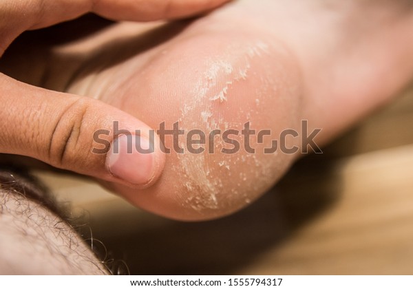 peeling skin on heels of feet