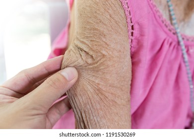 Hand Pinch Skin Of Old Woman,  Flexible Skin Test