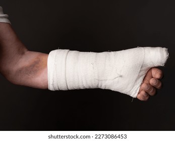 Hand in plaster, big bruise on hand. Cropped photo of a man. After surgery. Joint replacement. Prerel. - Shutterstock ID 2273086453