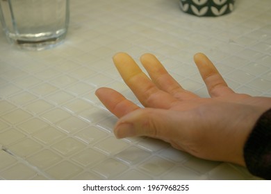 A Hand With Raynaud Syndrome Symptoms