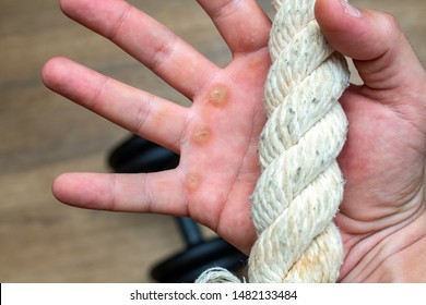 Hand With Rope Corn, Callus, Callosity, Induration, Congelation On The Palm Because Of Physical Activity Sports Gym Sport Concept