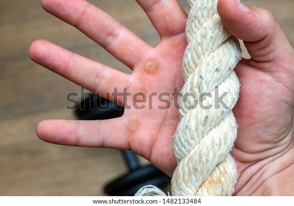 Hand with rope corn, callus, callosity,\
induration, congelation on the palm because of physical activity\
sports gym sport concept