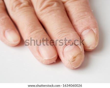 Hand roughness, detergent rash, onychomycosis (tsumehakusen) image