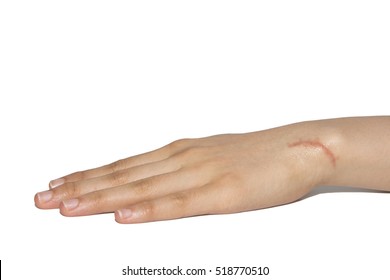 Hand With Scar Isolated On White