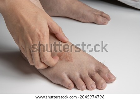 hand scratching foot infected by ringworm, athlete's foot or tinea pedis fungal infection. on white background.