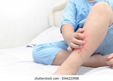Hand scratching  legs fat boy and swelling spot  sore   scar from mosquitoes bite allergy  Health care concept