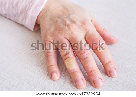 Hand with second degree burns on the fingers