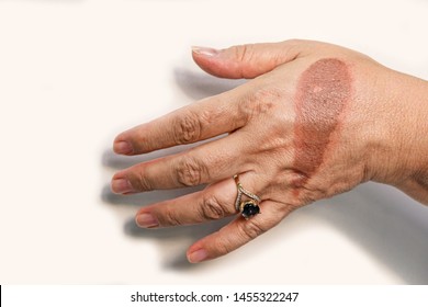 Hand Of Senior Woman With Second Degree Injury Thermal Burn Of Skin After Boiling Water On White Background. Home Accident, Careless Behavior With Boiling Tea. On Finger Is Jewel Ring With Blue Stone