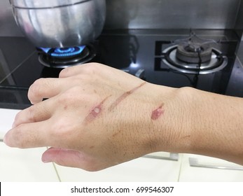 Hand Skin Burn From Cooking Oil Splash