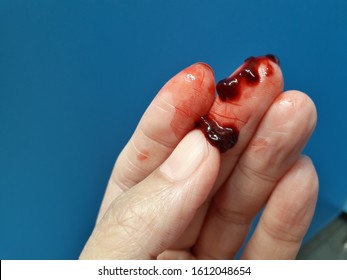 Hand Stain Deep Red Blood Clot In Hand Symptoms Of Hemorrhage Are Life Threatening When There Is Blood Flowing Out Of The Body, Should Seek Medical Attention To Treat.