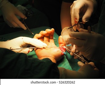 Hand Surgery With Plastic Surgeons