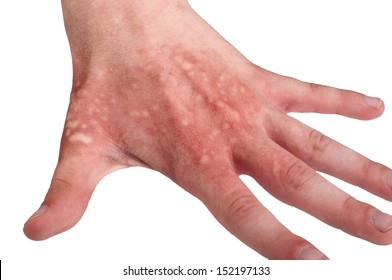 Skin Burn Images Stock Photos Vectors Shutterstock
