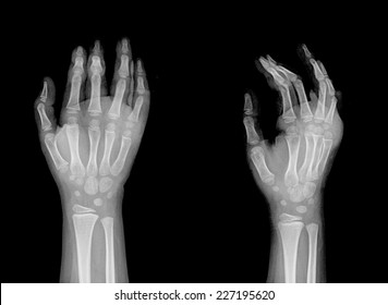 Hand Two Projections Xray Stock Photo 227195620 | Shutterstock