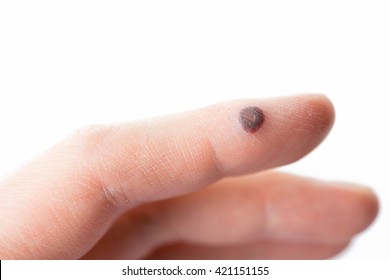 hand with wart isolated on white background