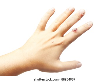 Hand With Warts Isolated On White Background