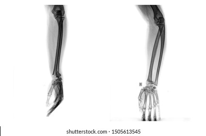 Hand And Wrist   Human Bones X Rays Radiology For Radiograp Student.