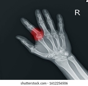 Hand and wrist x-ray showing closed fracture of proximal phalanx of right index finger causing displacement and deformity. on red mark .Hand injury. 