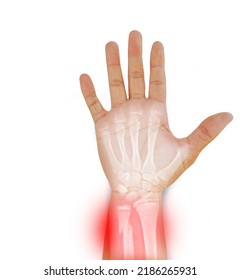 Hand and wrist x-ray view fracture distal ulna pain and swelling ,Medical image concept on white background. - Shutterstock ID 2186265931