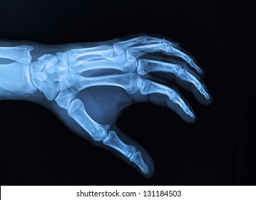 Hand Xray Image Medical Background