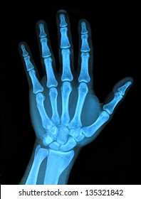 Hand Xray Image Medical Background