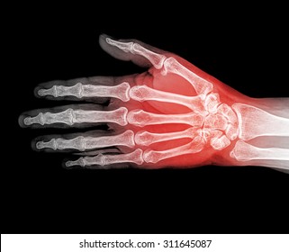 Hand Xray Image Medical Background