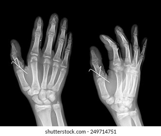 Hand Xray Image Medical Backgroundthumb Painful Stock Photo 249714751 