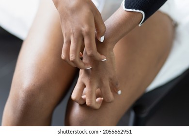 Hand Of Young Black African Woman Scratching Her Hand Skin, Concept Of Easy Allergic Skin, Dry Itching Skin, Unhygienic Skin Care, Ringworm, Rash, Redness