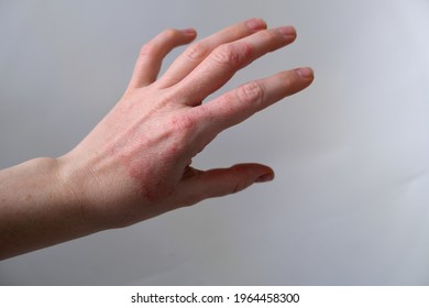 Hand Of A Young Woman With Flaky Skin Due To Eczema Or Atopic Dermatitis. Damaged Skin Of A Woman's Hand From A Skin Ailment Dermatitis.