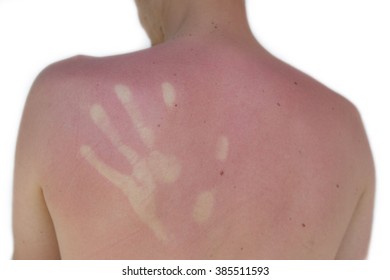 Handprint / Sunburn On The Shoulder Of A Young Man