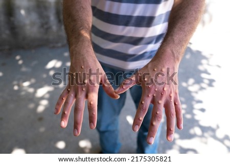 hands affected by smallpox. Man with blisters on his hands from monkeypox.