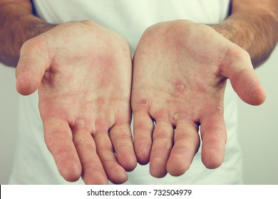 Hands With Blister And Callus