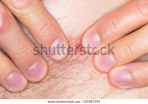 Hands Caucasian Man Squeezing Pimple Due Stock Photo Edit Now