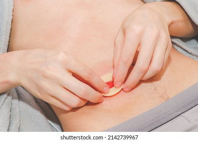 The hands of a caucasian young man presses an adhesive circle around the protruding small intestine on the stomach,  top view.Concept step-by-step replacement of a colostomy bug at home, abdominal dis