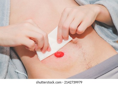 The hands of a caucasian young man wipe with a sterile dry napkin the small intestine brought out on the stomach, top view .Concept step by step replacement of the colostomy bug at home, abdominal dis