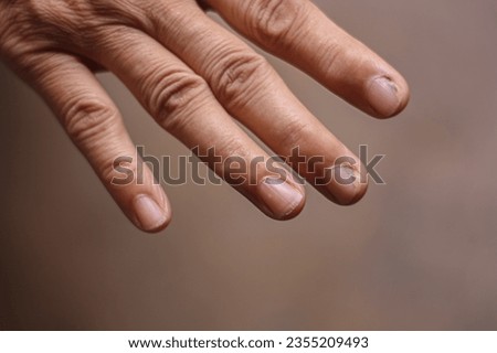 hands containing fungus in nails, finger, hand fungus, medical, green fungus, blurry background nails fungus green, closeup, treatment, illness, sick, skin, hand skin nail, injury injured